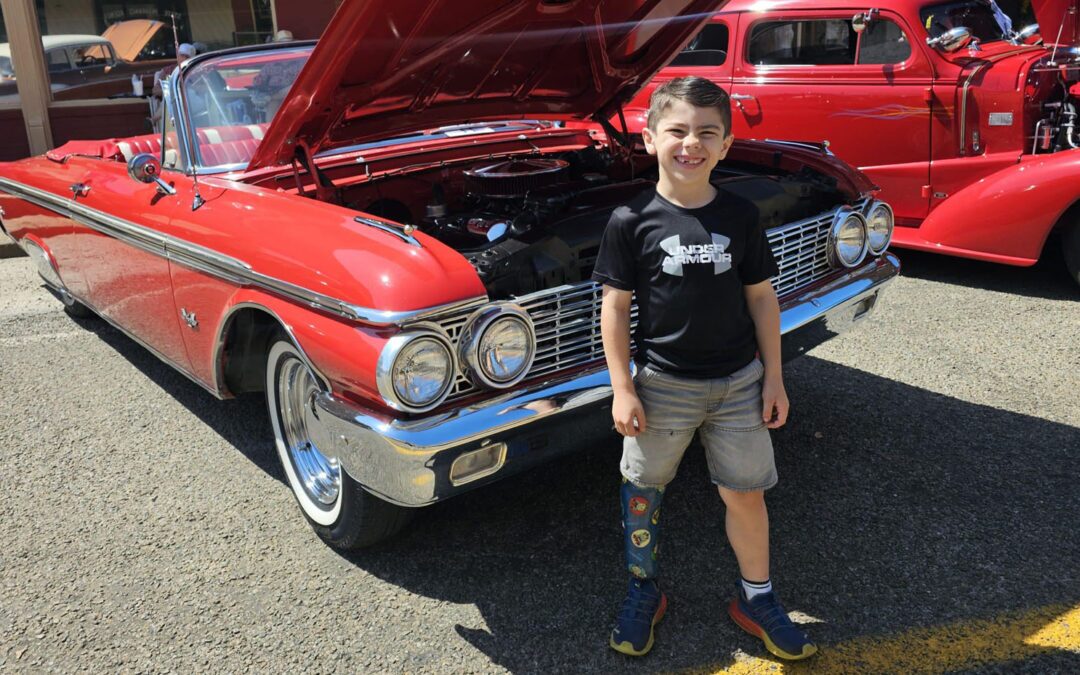 How Ryan Lives Life to the Fullest With A Limb Difference