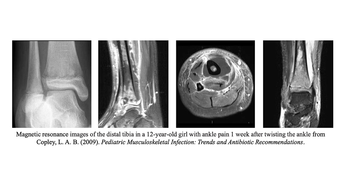 Norman-header-1 Magnetic resonance images of the distal tibia in a 12 year old girl with ankle pain | Magnetic resonance images of the distal tibia in a 12-year-old girl with ankle pain 1 week after twisting the ankle from Copley, L. A. B. (2009). Pediatric Musculoskeletal Infection: Trends and Antibiotic Recommendations.