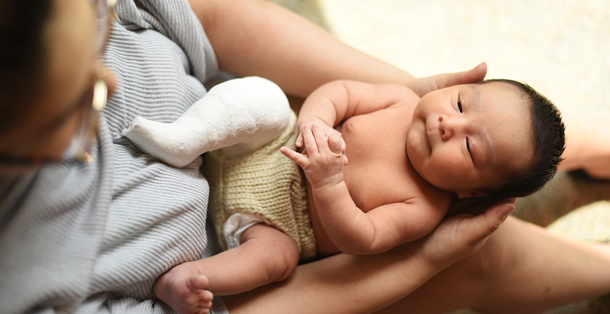 Clubfoot: What Parents Need To Know